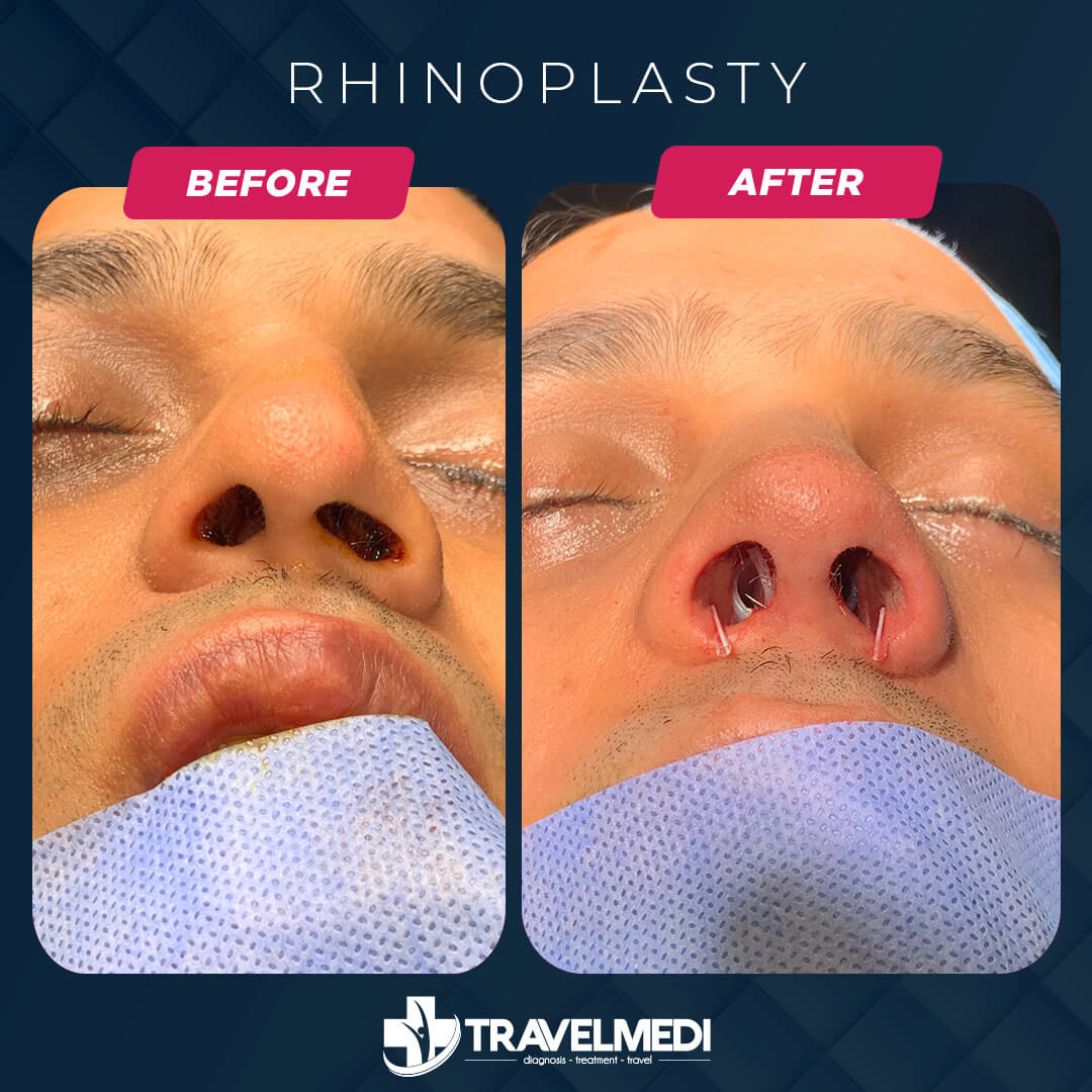 Rhinoplasty Before After in Turkey