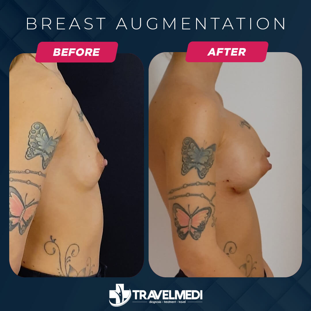 Breast Augmentation in Turkey Before After