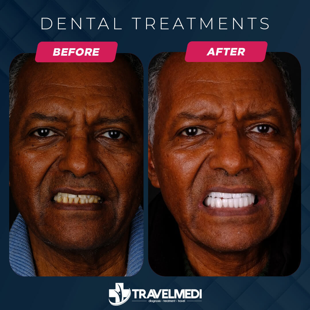 Dental treatments before after in Turkey