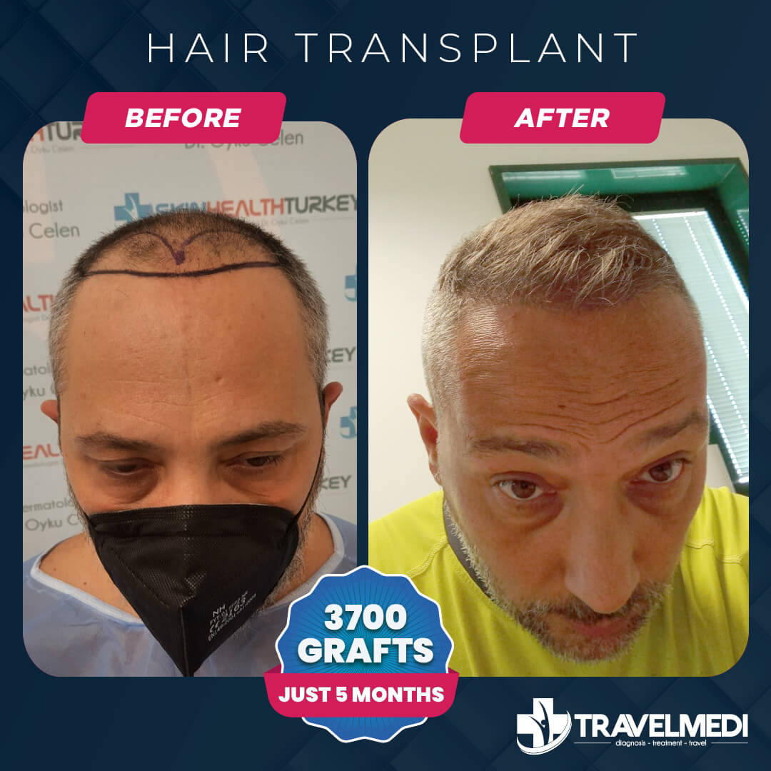 Resultat för hårtransplantation i Turkiet