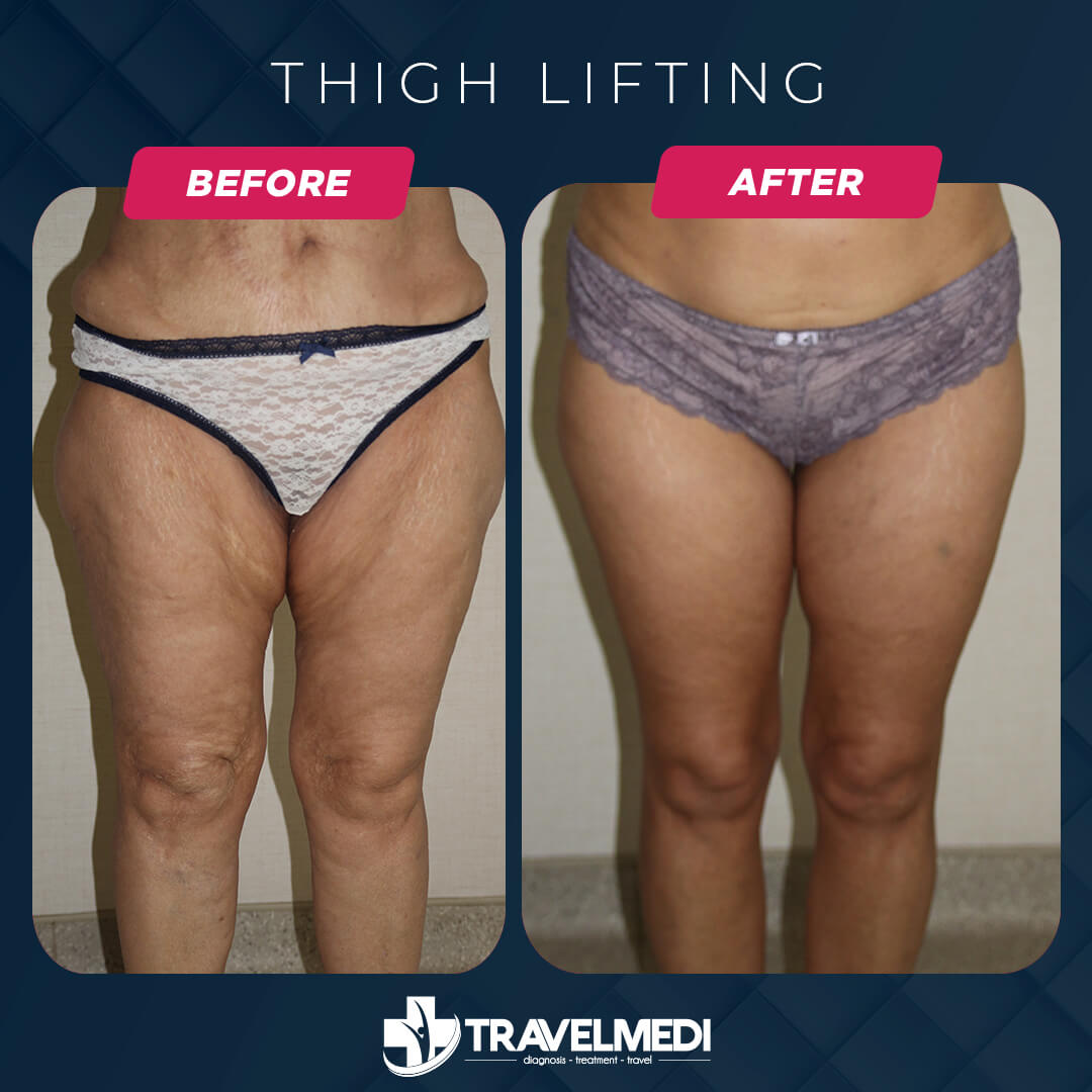 Thigh Lift before after in Turkey